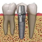 implantes dentales
