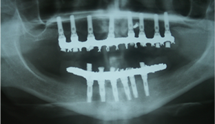 implantes dentales