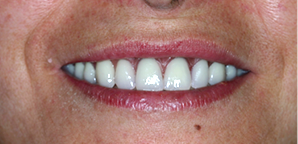 implantes dentales