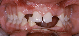 implantes dentales