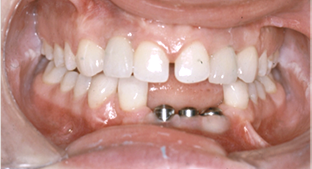 implantes dentales