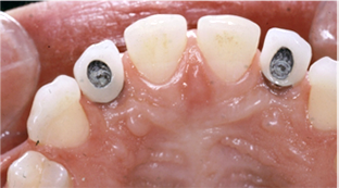 implantes dentales