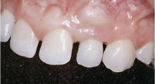 implantes dentales