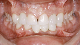 implantes dentales