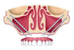 implantes dentales