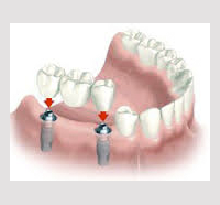implantes dentales