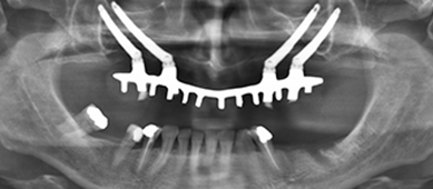 implantes dentales
