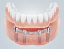 implantes dentales