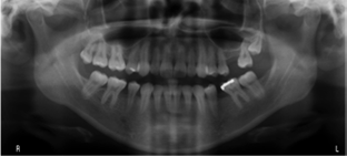 implantes dentales
