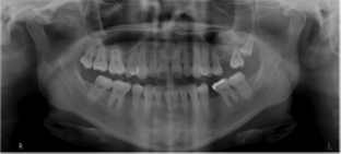 implantes dentales
