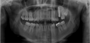 implantes dentales