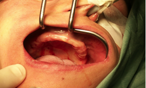 implantes dentales